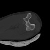 SPORK, NICO - 22.03.1976 - 02.08.2022 - CT obere Extremität - 18:02:23